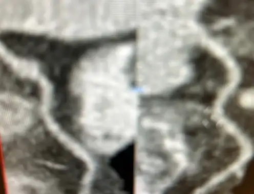 Innovative approach to chest pain evaluation for traveler